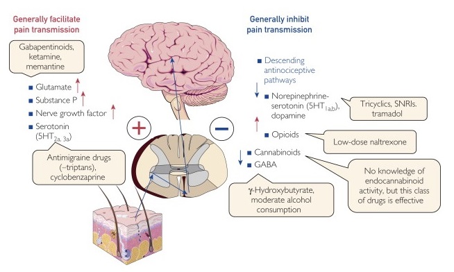 فیبرومیالژیا