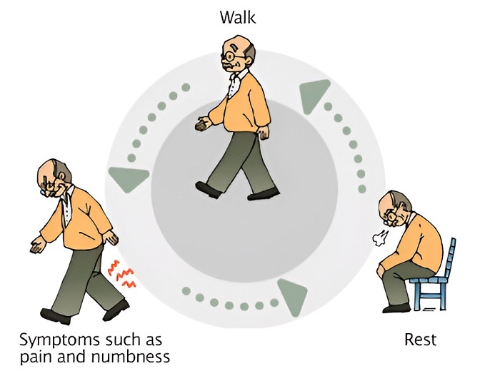 علائم تنگی کانال نخاعی