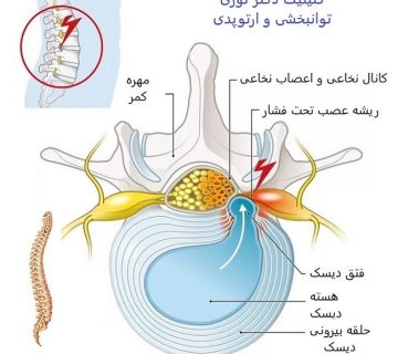 دیسک کمر؛ کمردرد و سیاتیک