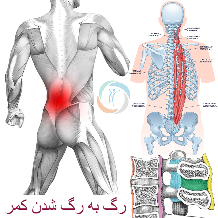 رگ به رگ شدن کمر