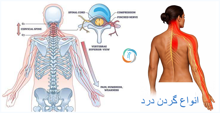 انواع گردن درد