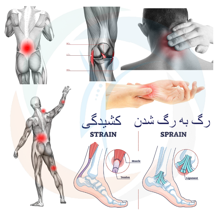رگ به رگ شدن و کشیدگی