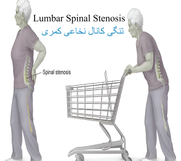 تنگی کانال نخاعی کمری
