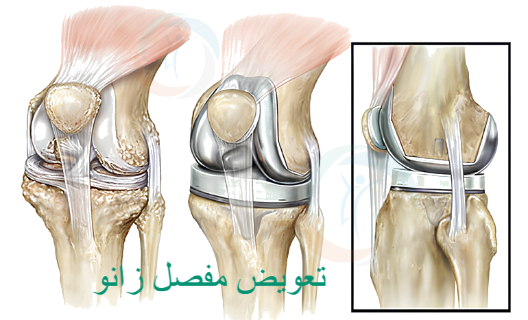 متخصص زانو تهران