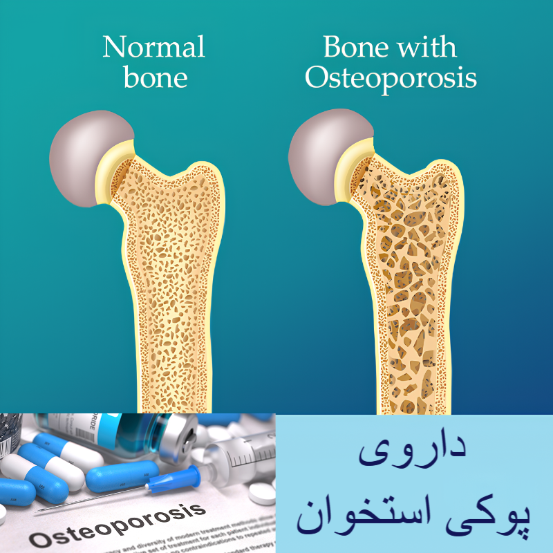 داروی پوکی استخوان