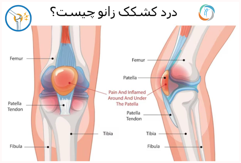درد کشکک زانو چیست؟
