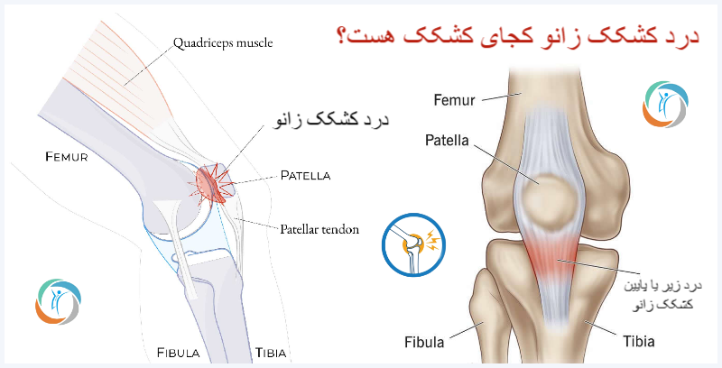 درد کشکک زانو کجای کشکک هست؟