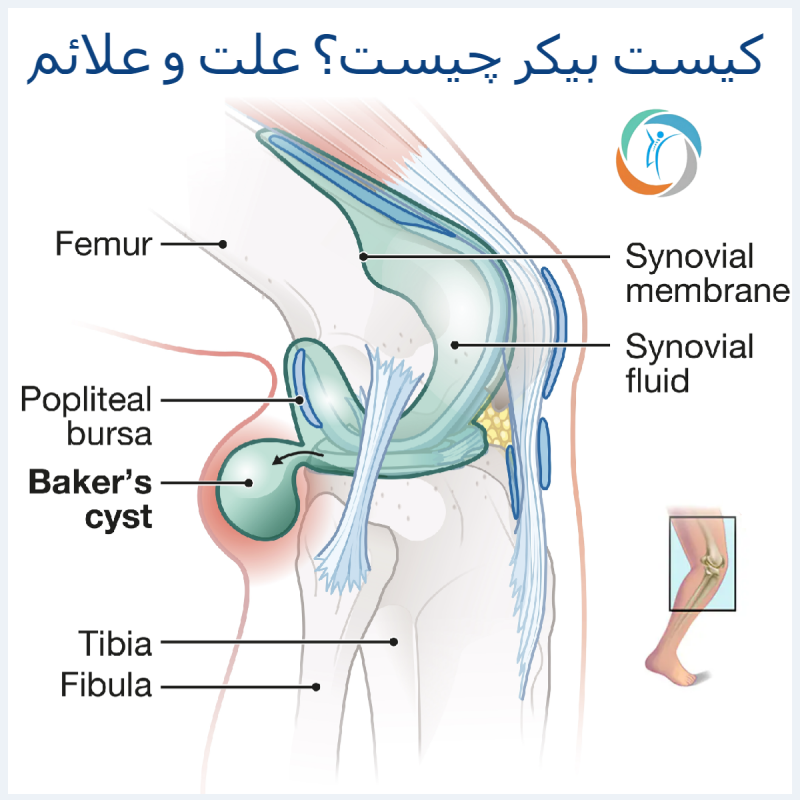 کیست بیکر چیست؟ علت و علائم