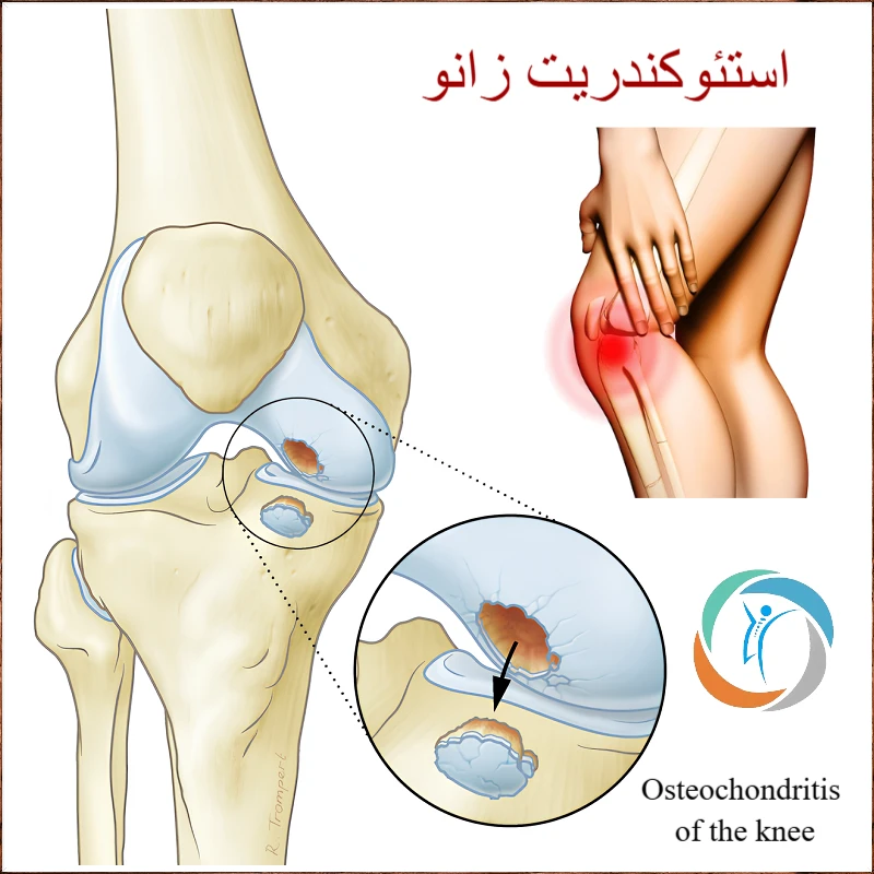 استئوکندریت زانو