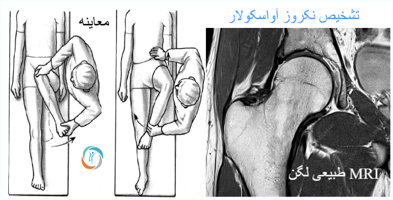 تشخیص نکروز آواسکولار
