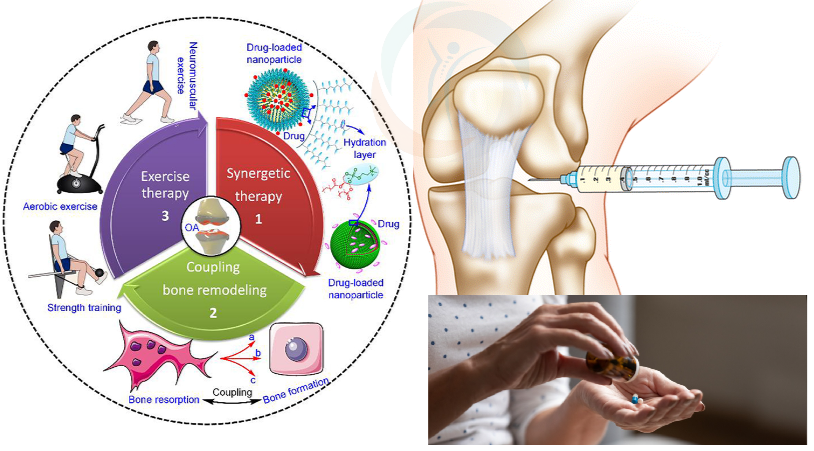 درمان آرتروز زانو با روش های مختلف