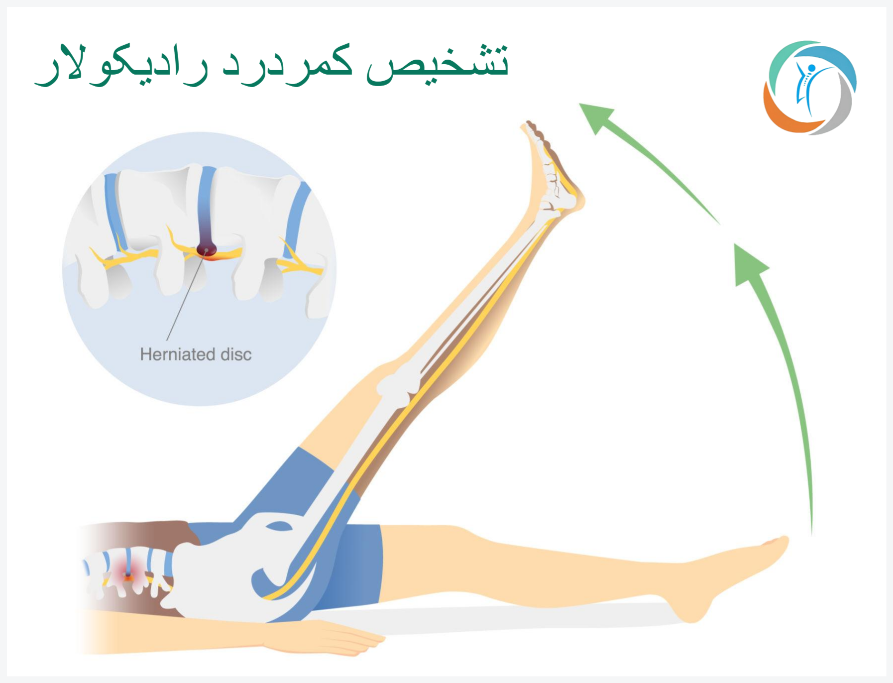 تشخیص کمردرد رادیکولار