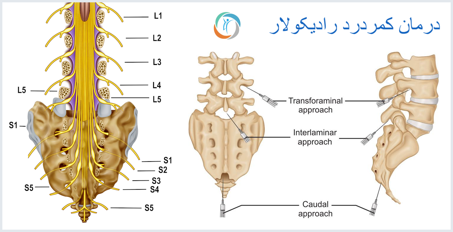 درمان کمردرد رادیکولار