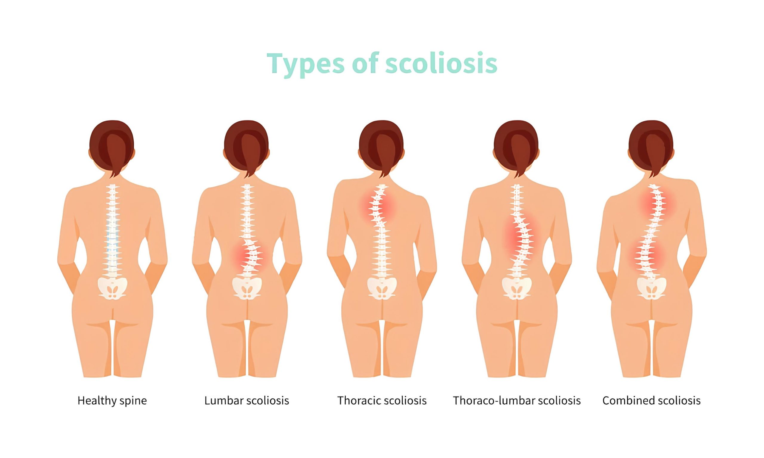 انواع اسکولیوز