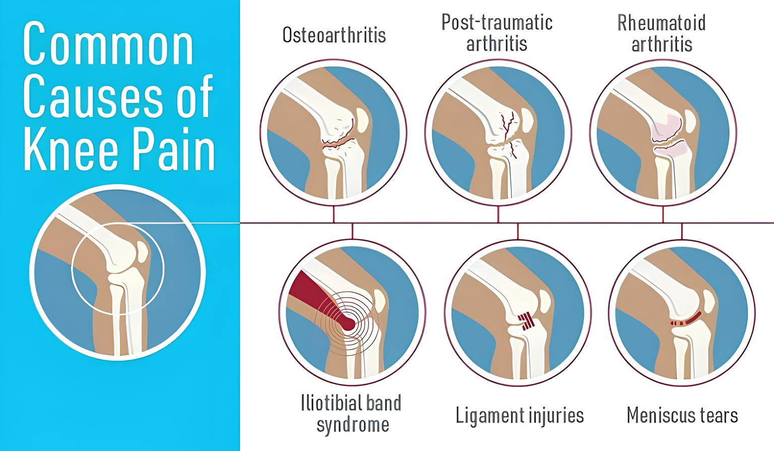 درمان خانگی زانو درد