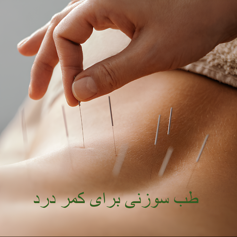 طب سوزنی برای کمر درد