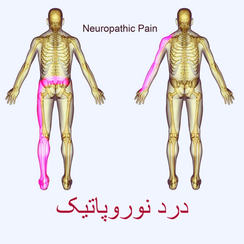 درد نوروپاتیک
