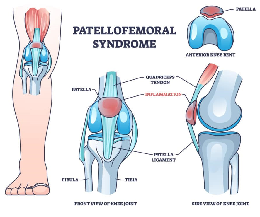 نرمی کشکک زانو