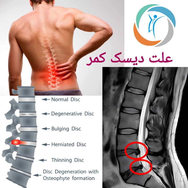 علت دیسک کمر