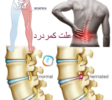 علت کمردرد چیست