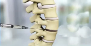 تزریق به کمر