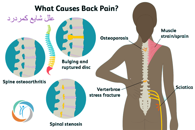 علت کمردرد