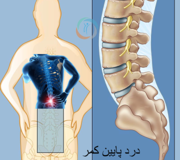 درد پایین کمر