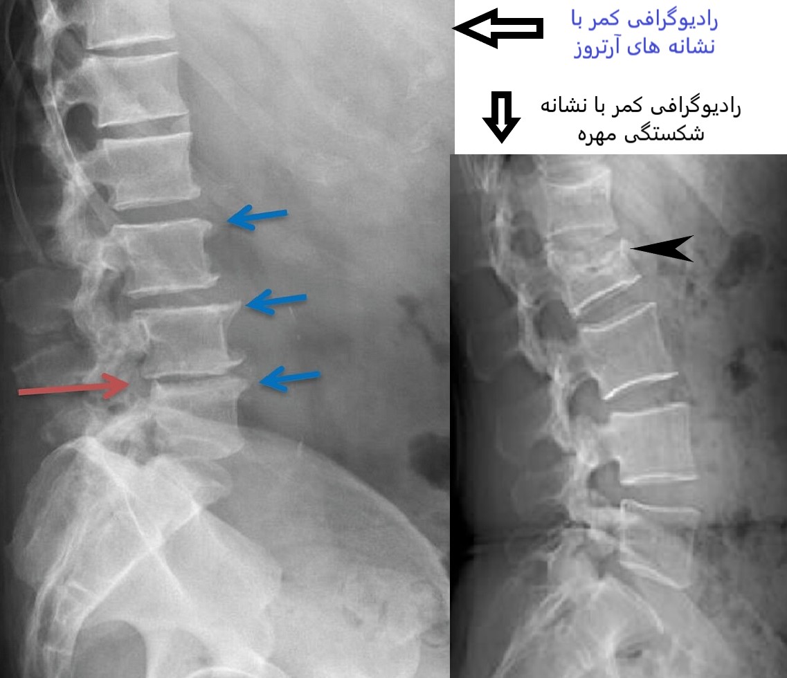 درمان آرتروز کمر و ستون فقرات