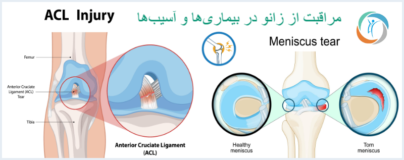 مراقبت از زانو در بیماری‌ها و آسیب‌ها