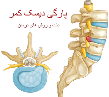 پارگی دیسک کمر