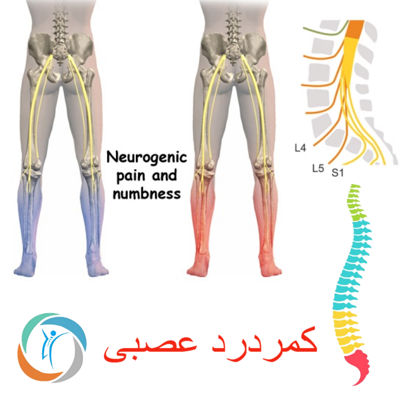 کمردرد عصبی