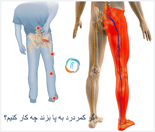 اگر کمردرد به پا بزند چه کار کنیم؟
