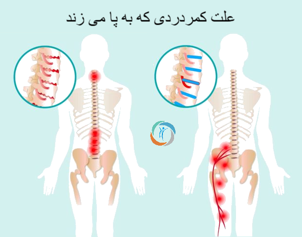 علت کمردردی که به پا می زند