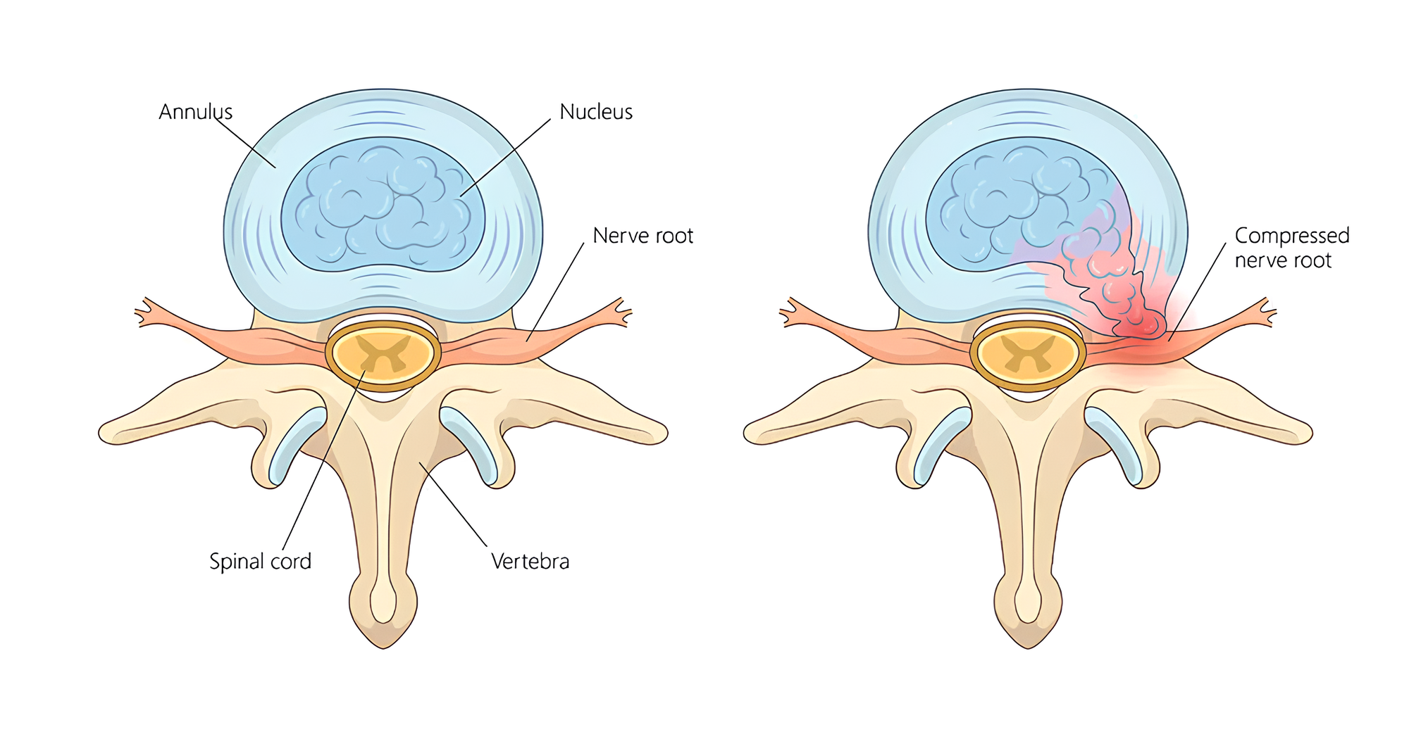متخصص دیسک کمر