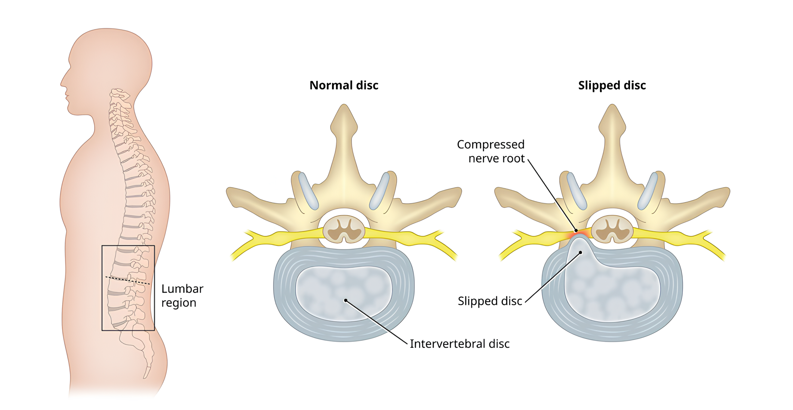 علت دیسک کمر