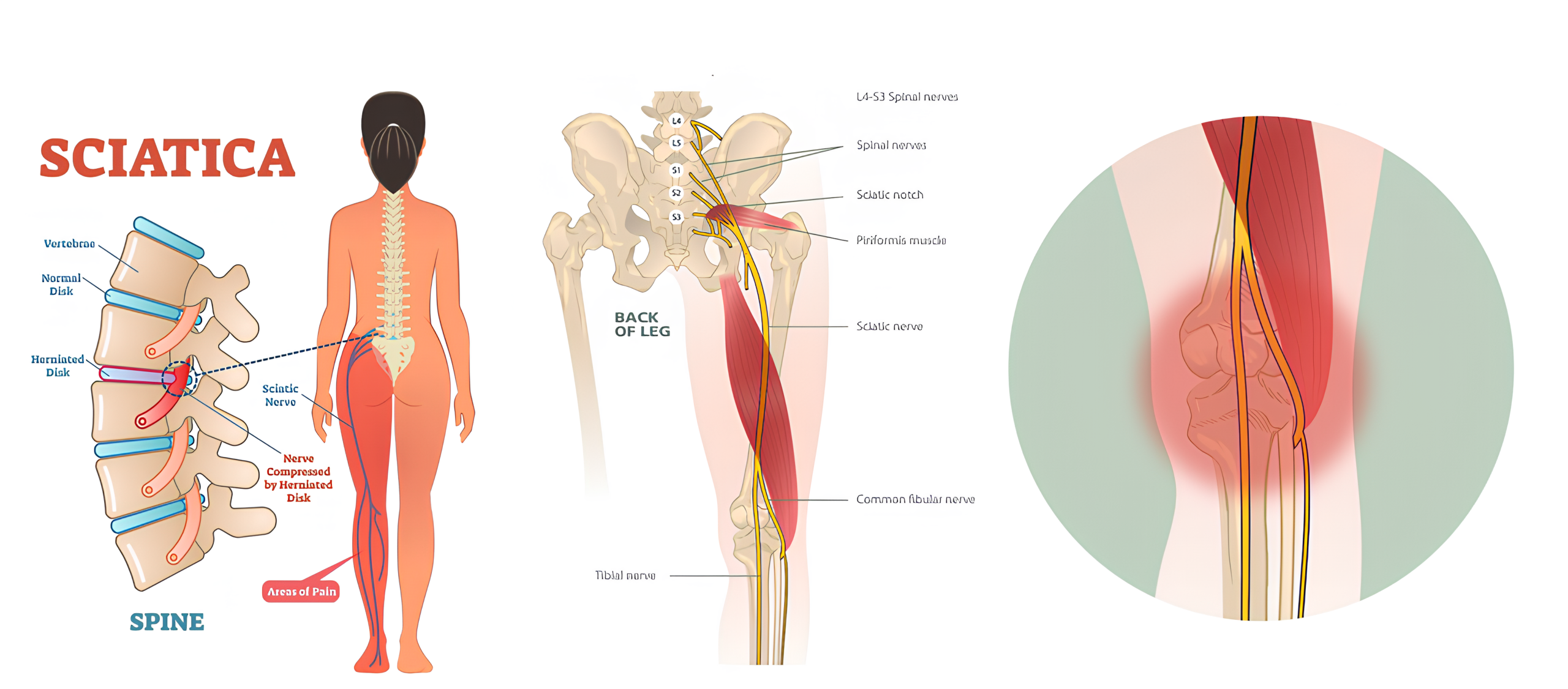 زانو درد عصبی