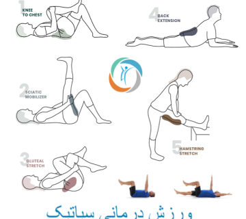 ورزش درمانی برای سیاتیک