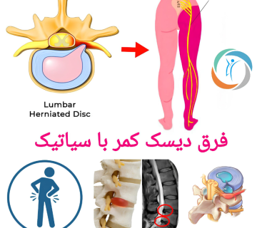 فرق دیسک کمر با سیاتیک