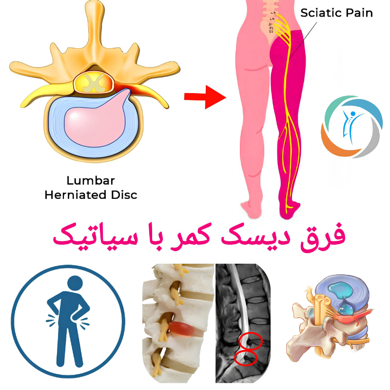 فرق دیسک کمر با سیاتیک