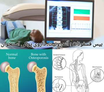 بیس فسفونات ها؛ داروی پوکی استخوان