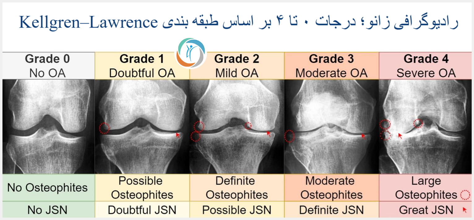رادیوگرافی زانو؛ درجات ۰ تا ۴ بر اساس طبقه‌بندی Kellgren–Lawrence