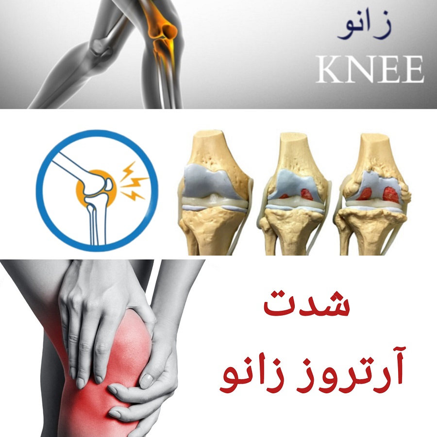 شدت آرتروز زانو