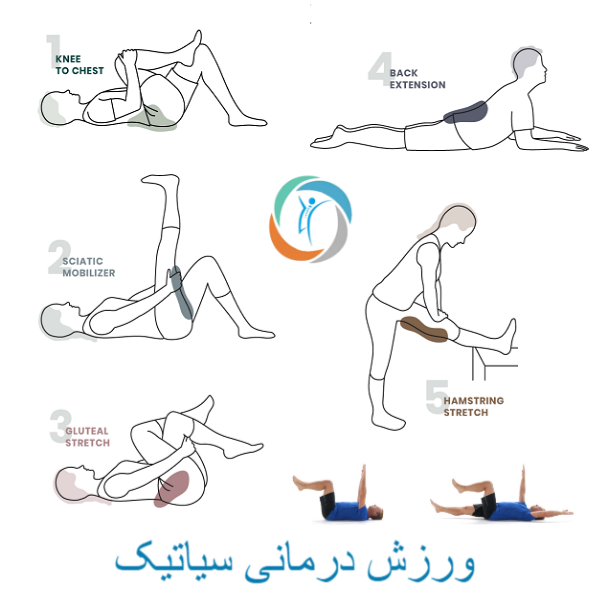 ورزش درمانی سیاتیک