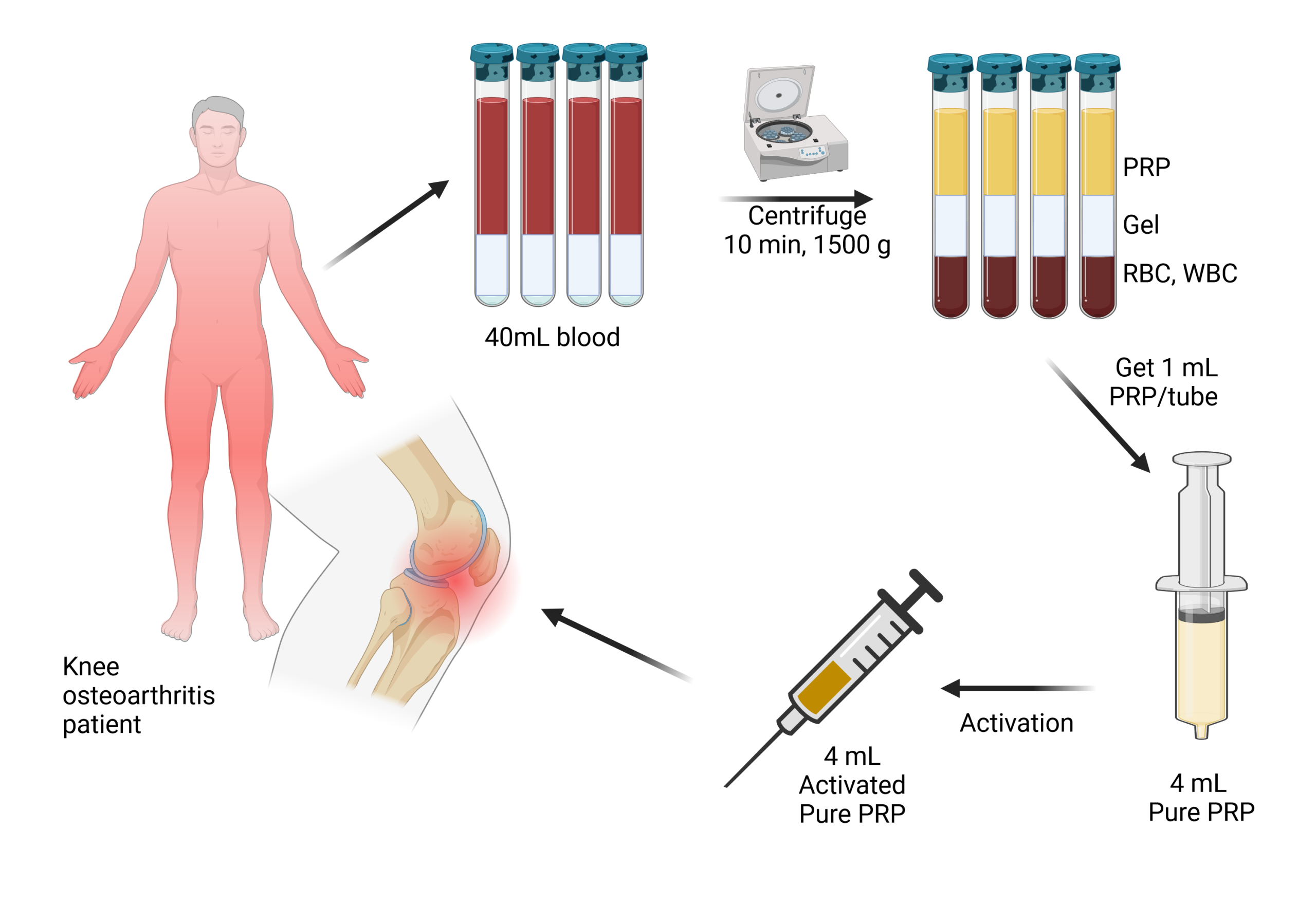 نحوه انجام پی آر پی آرتروز زانو