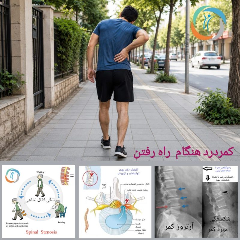 کمردرد هنگام راه رفتن