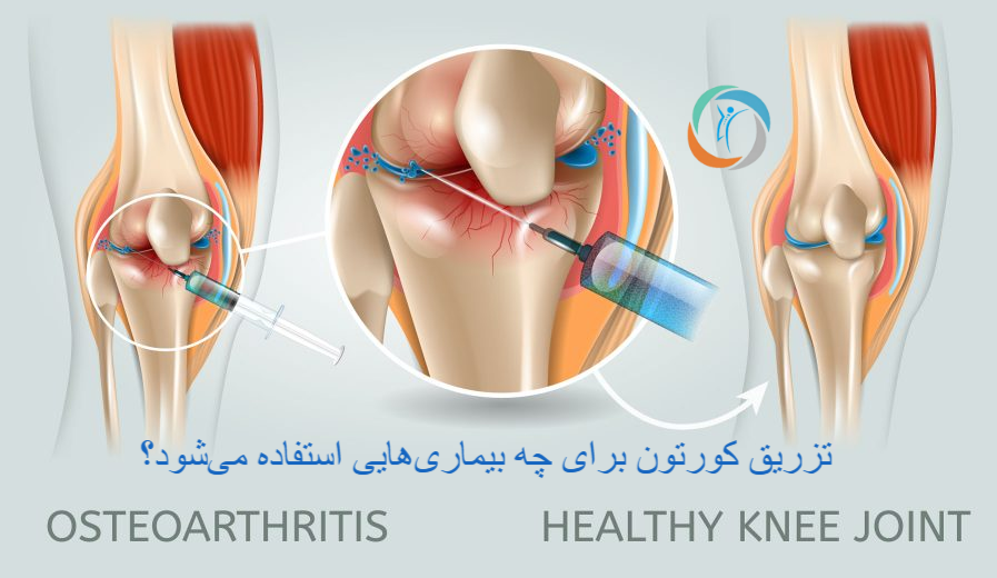 تزریق کورتون برای چه بیماری‌هایی استفاده می‌شود؟