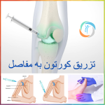 تزریق کورتون به مفاصل