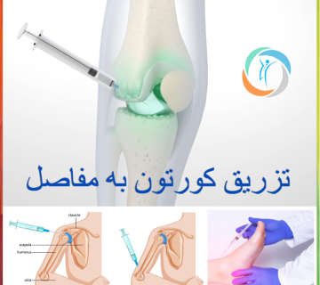 تزریق کورتون به مفاصل