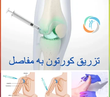 تزریق کورتون به مفاصل