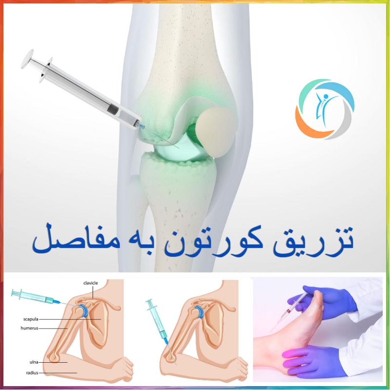 تزریق کورتون به مفاصل
